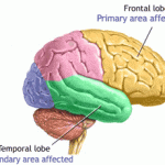 Protein chống lại bệnh Alzheimer’s?