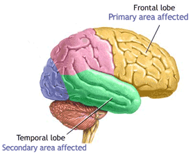 Protein chống lại bệnh Alzheimer’s?