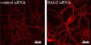 Tiến triển trong việc nghiên cứu bệnh Alzheimer
