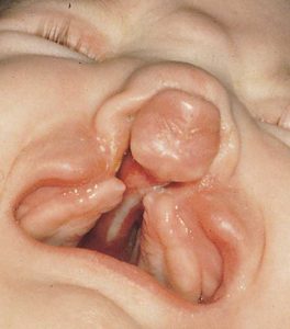 Chìa khóa tiến hóa của rối loạn khi sinh