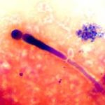 Viêm nhiễm âm đạo do nấm candida