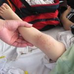 Bệnh tay-chân-miệng đang có biểu hiện bùng phát