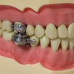 Thiết bị khóa hàm răng cho người muốn giảm cân