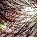 Lời khuyên cho bệnh ngứa