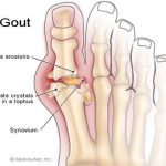 Bệnh thống phong: Uống cà phê, giảm nguy cơ mắc bệnh