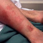 Dịch ban đỏ bùng phát tại Hồng Kông