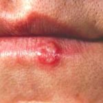 Các tổn thương mô miệng ở trẻ em