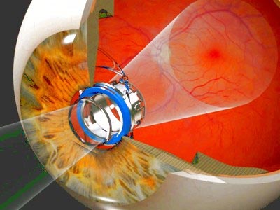 Kính viễn vọng siêu nhỏ giúp cải thiện thị lực