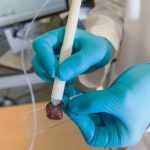 Chiếc bút phát hiện ung thư trong 10 giây