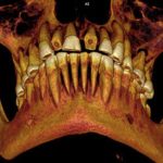 Phát hiện xác ướp chết vì sâu răng