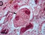 Nhiễm nấm Panicillium marneffei: Một chỉ điểm AIDS
