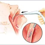 Kỹ thuật mới điều trị ngưng thở khi ngủ do ngáy
