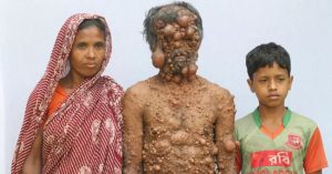 Người đàn ông “trăm u” bị xa lánh ở Bangladesh