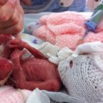 Bé sinh non được sống nhờ bác sĩ cân nhầm