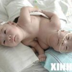 Trung Quốc: Mổ tách rời cặp song sinh dính liền