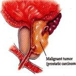 Phát hiện bộ gene độc đáo gây ung thư tiền liệt tuyến