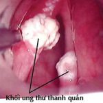 Amiante: Thủ phạm gây ung thư