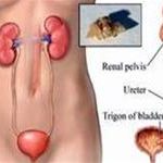 Sỏi niệu và những biến chứng nguy hiểm