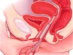 Hợp chất mới diệt tinh trùng