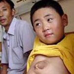 Người có quả tim nhô ra ngoài