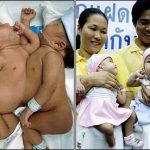 Thái Lan: Tách rời thành công cặp song sinh dính liền tim