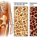 Loãng xương: 35 tuổi trở lên, phải đề phòng