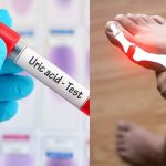 Top 10 cách “đào thải” acid uric một cách tự nhiên, ngừa gout hiệu quả: Nhiều người chưa biết để làm!