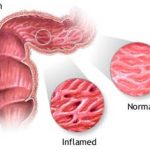 Vi khuẩn có trong sữa bò gây bệnh đường ruột Crohn
