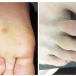 Phát hiện triệu chứng mới ở bàn chân người mắc Covid-19