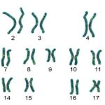 Hội chứng mèo kêu: Nguyên nhân, triệu chứng và cách điều trị