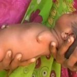Bé gái Sọ Dừa phiên bản Ấn Độ sinh ra đã giống cục thịt không có tay chân