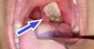 Cách phân biệt bệnh bạch hầu và viêm họng
