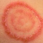 Bệnh hắc lào: Nguyên nhân, triệu chứng và cách điều trị