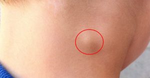 Bệnh lao hạch: Nguyên nhân, triệu chứng và cách điều trị