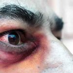 Bệnh nấm đen (Mucormycosis) là gì?