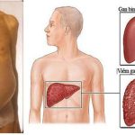 Xơ gan cổ trướng là gì? Triệu chứng, chẩn đoán và điều trị