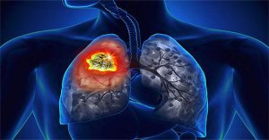 Bệnh bụi phổi silic là gì?