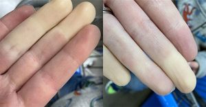 Bệnh mùa lạnh khiến ngón tay trắng bệch một cách kỳ lạ