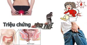 Các cấp độ của bệnh trĩ, nguyên nhân, cách phòng tránh và chế độ ăn uống