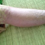 Phát hiện sáu loại gen mới gây nên bệnh vẩy nến