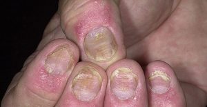 8 nguyên nhân chính gây ra bệnh vẩy nến