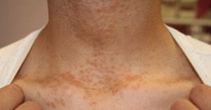 Cẩn trọng bệnh về da do đi mưa và lội nước ngập