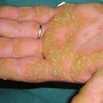 Phát hiện gene gây bệnh đốm da