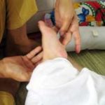 Bệnh tay, chân, miệng: Cảnh báo biến chứng thần kinh
