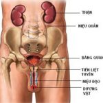 Phương pháp chữa ung thư bàng quang hiệu quả