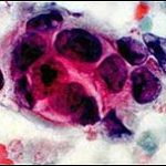 Phát hiện 4 gene ung thư mới