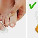 Những cách tự nhiên chữa móng chân mọc lệch đâm vào da thịt