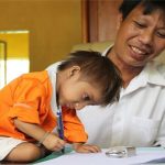 Hội chứng Seckel (người lùn đầu chim) là gì?
