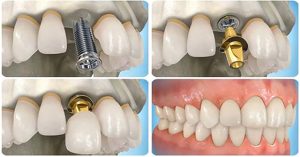 Cấy ghép răng implant là gì?