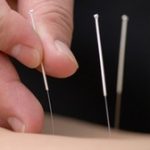 Giảm bệnh chàm bằng trà và châm cứu